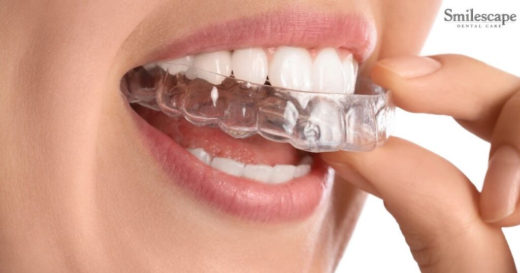 Teeth Alignment in Anna Nagar