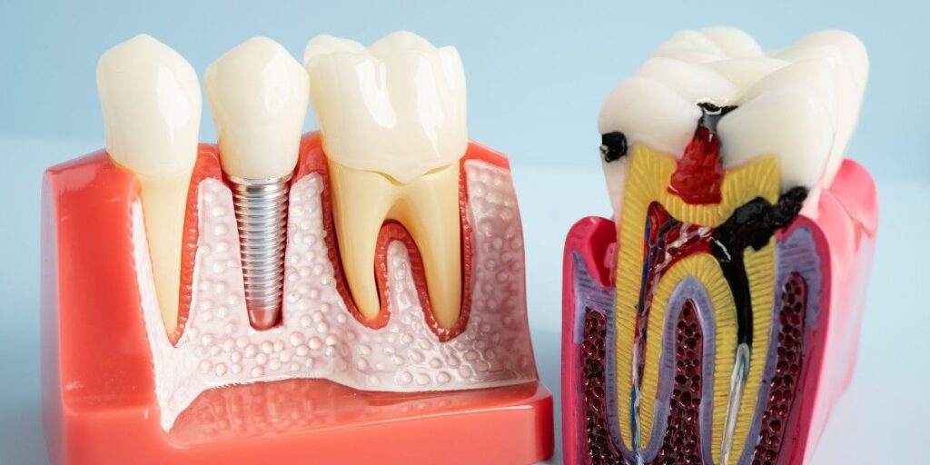  RCT treatment in Anna Nagar