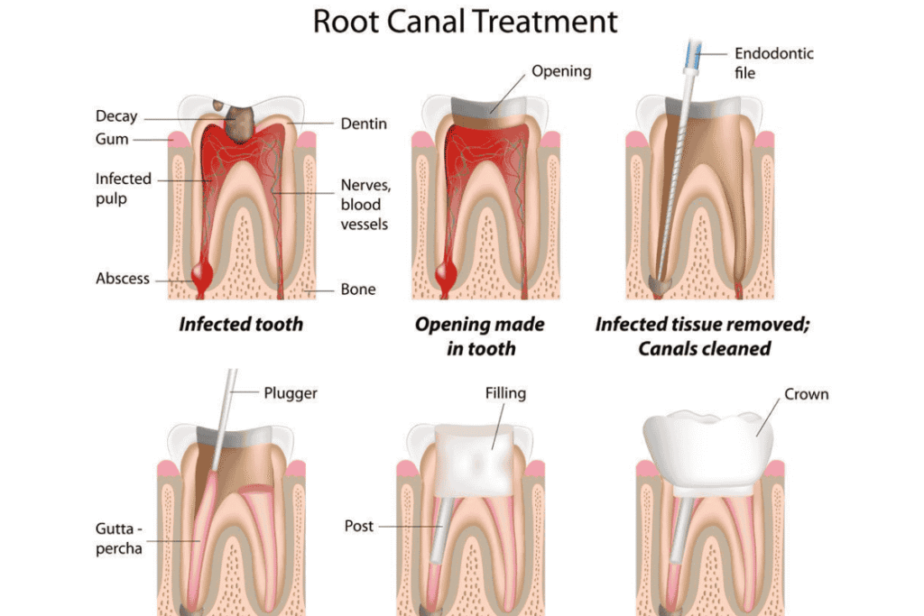 RCT treatment in Anna Nagar