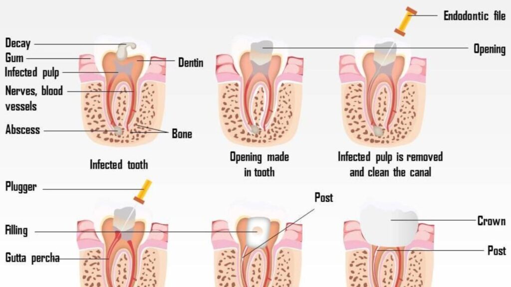 root canal procedure from infected tooth to final crown restoration.