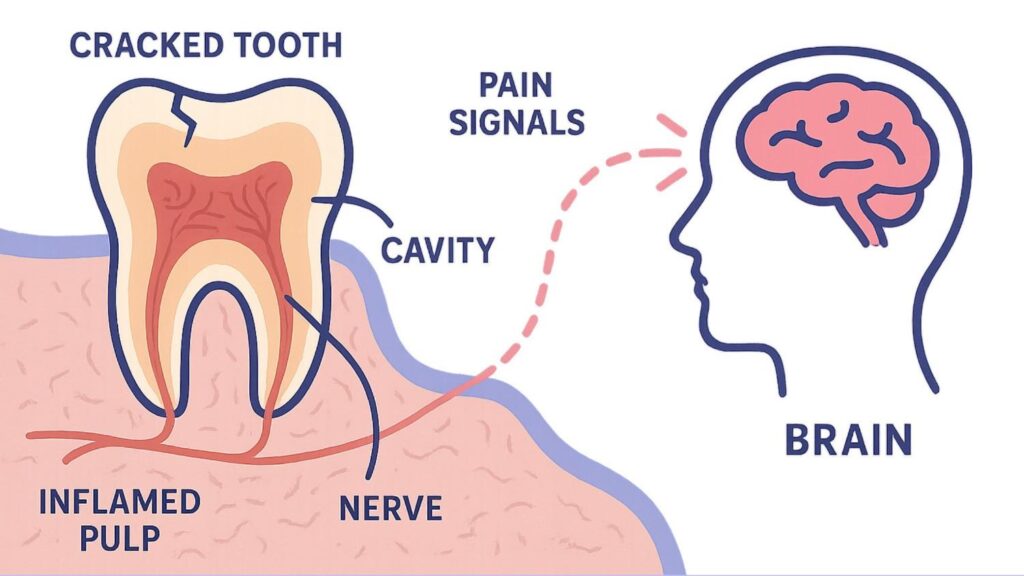 tooth pain when biting down due to cracked tooth and inflamed pulp.