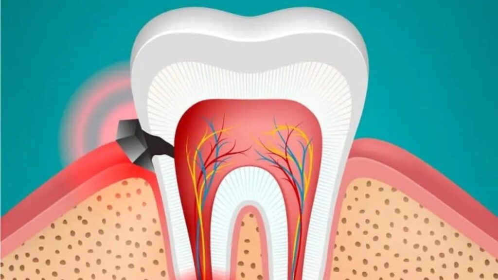 swollen gums and facial swelling due to dental abscess.