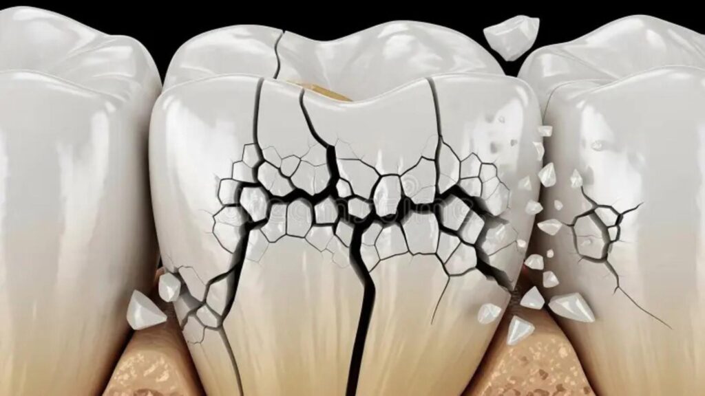 severely cracked tooth with enamel fragments breaking off.