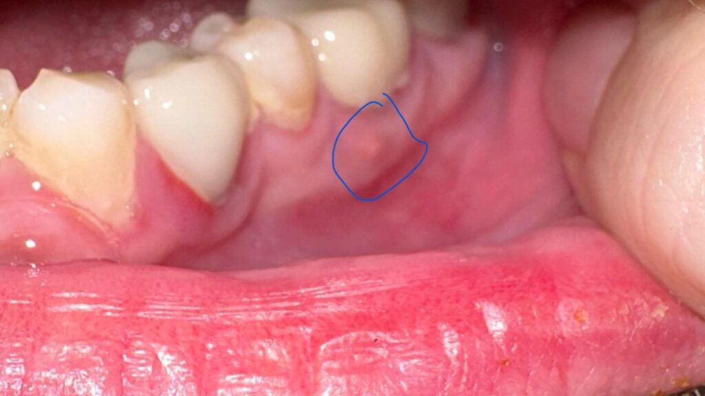 gum with pimple-like bump indicating dental fistula or abscess drainage.