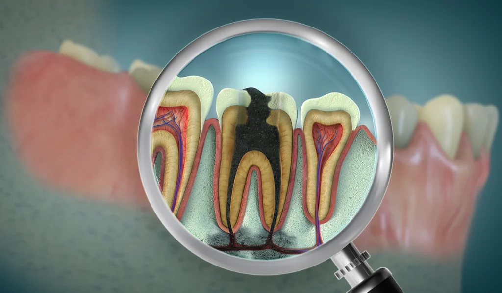 showing discolored darkened tooth compared to surrounding healthy teeth.