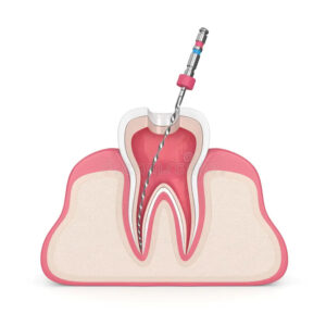 Root Cannal Treatment in Tiruvannamalai