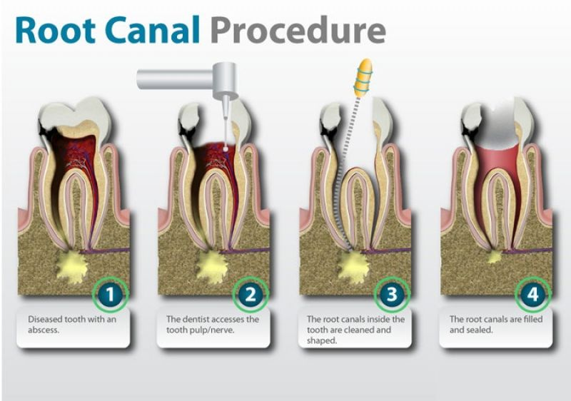 Root Canal Treatment in Anna nagar