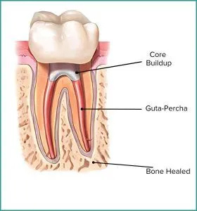 Root Canal Treatment
