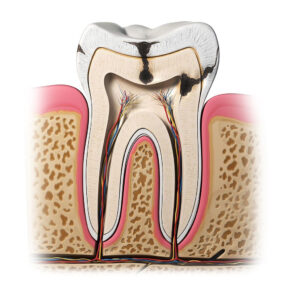 Root Canal Treatment in Salem