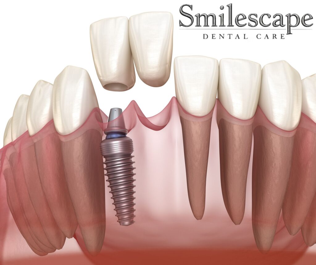 Dental implant in anna nagar