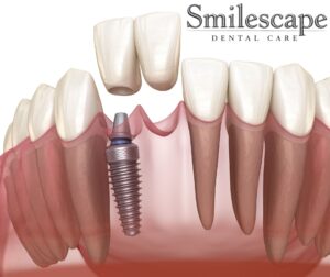 Dental implant in anna nagar