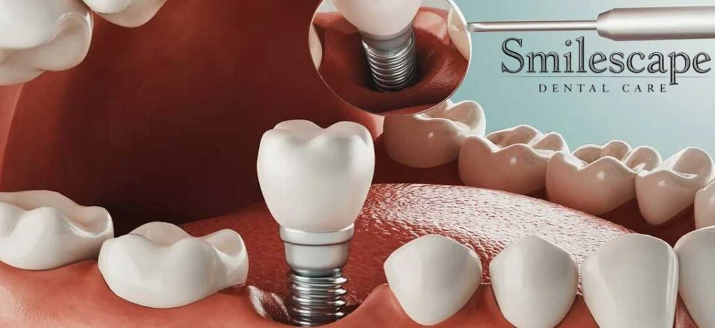 dental implant in anna nagar