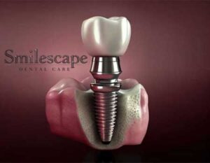 dental implant in tiruvallur