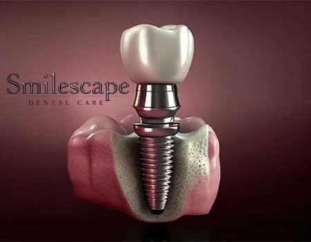 dental implant in tiruvallur