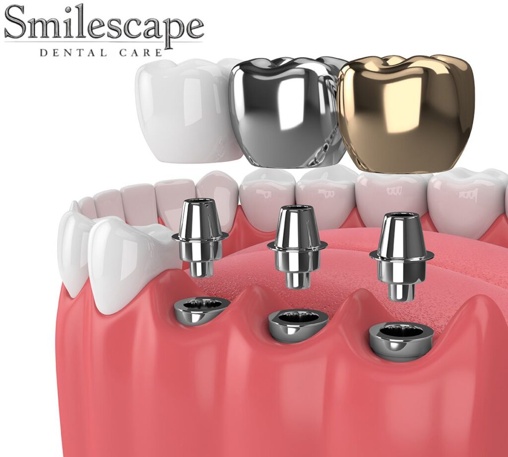 dental implant in tiruvannamalai