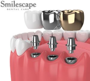 dental implant in tiruvannamalai