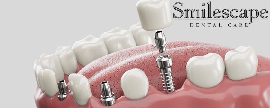 dental implant in tiruvannamalai