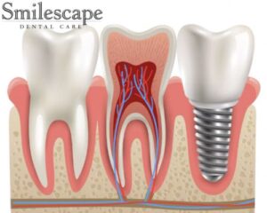 dental implant in salem