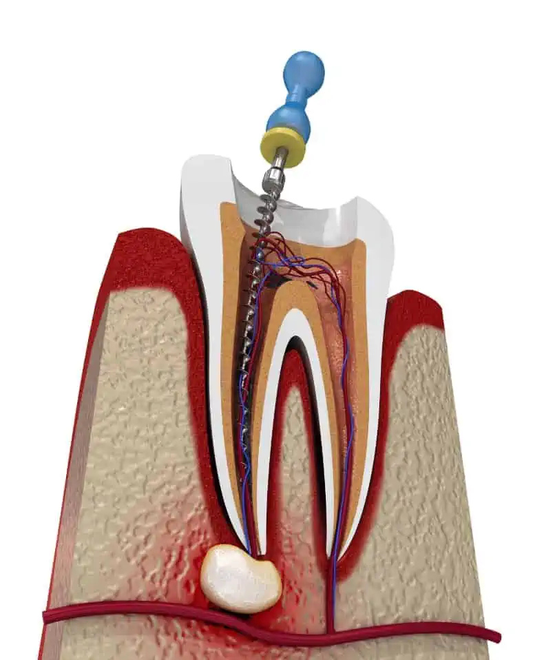Root Canal Treatment in Tiruvallur