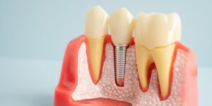 RCT treatment in Anna Nagar