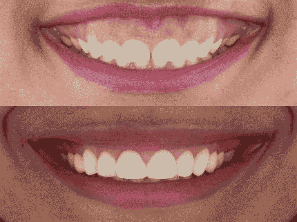 Gum Contouring & Smile Design