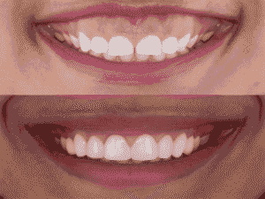Smile Makeover in tiruvannamalai