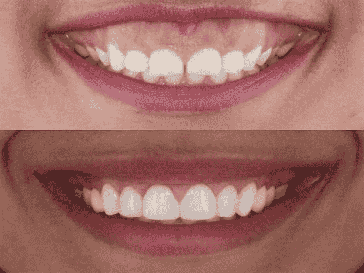 Smile Makeover in Anna Nagar